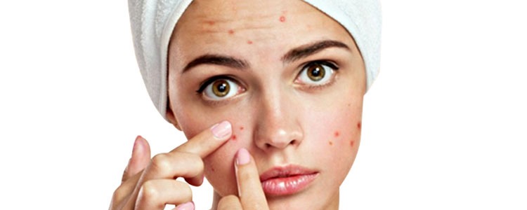 Acne Treatment in Pune